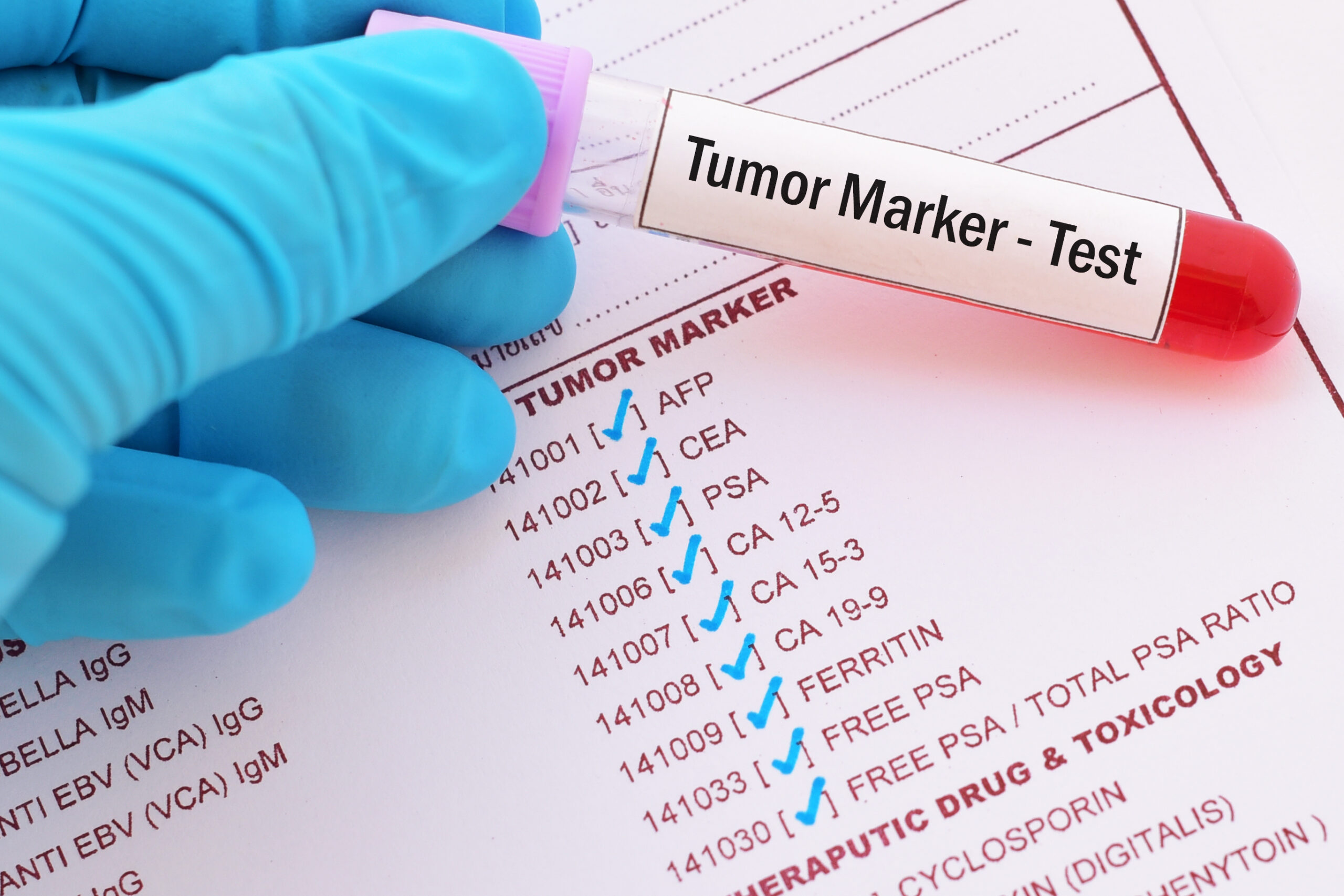Test tube with blood sample for tumor marker test
